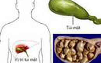 Ung thư t&#250;i mật v&#224; những điều cần biết